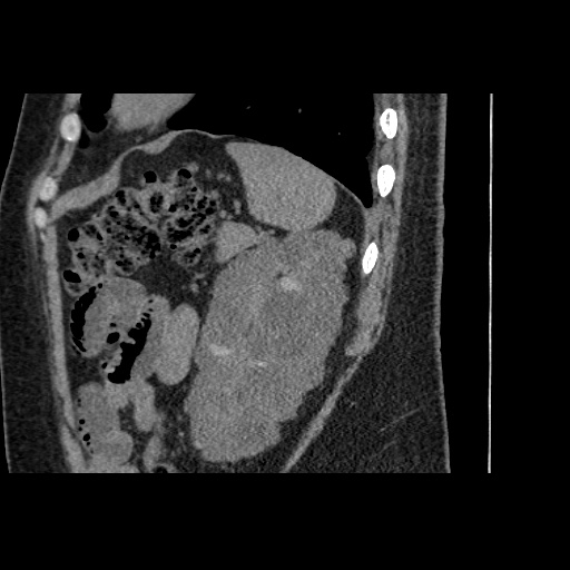Adult polycystic kidney disease (Radiopaedia 59075-66368 Sagittal non-contrast 73).jpg