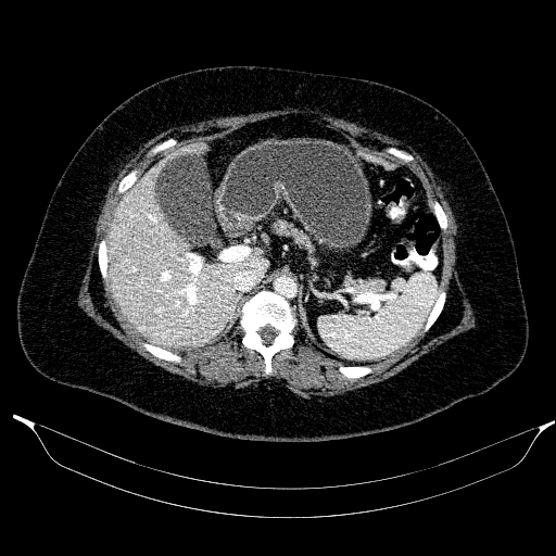 Afferent loop syndrome - secondary to incarcerated trocar site hernia (Radiopaedia 82959-97305 Axial C+ portal venous phase 64).jpg