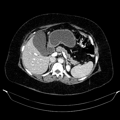 Afferent loop syndrome - secondary to incarcerated trocar site hernia (Radiopaedia 82959-97305 Axial C+ portal venous phase 71).jpg