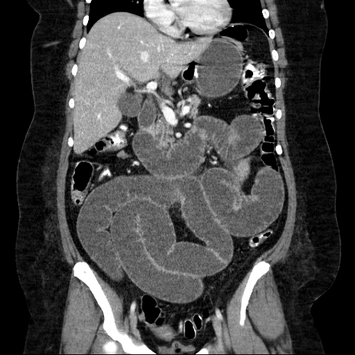 File:Afferent loop syndrome - secondary to incarcerated trocar site hernia (Radiopaedia 82959-97305 Coronal C+ portal venous phase 76).jpg