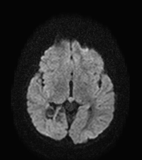 File:Aicardi syndrome (Radiopaedia 66029-75205 Axial DWI 11).jpg