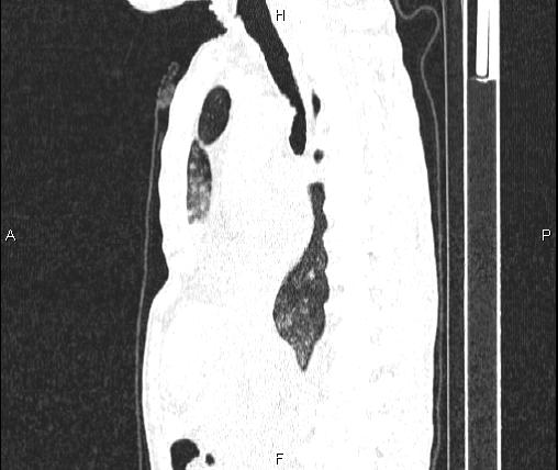 File:Air bronchogram in pneumonia (Radiopaedia 85719-101512 Sagittal lung window 48).jpg