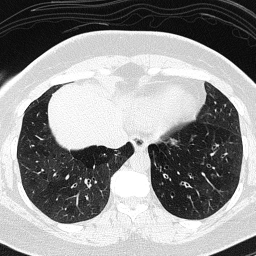 Air trapping in small airway disease (Radiopaedia 61685-69694 Axial lung window 142).jpg