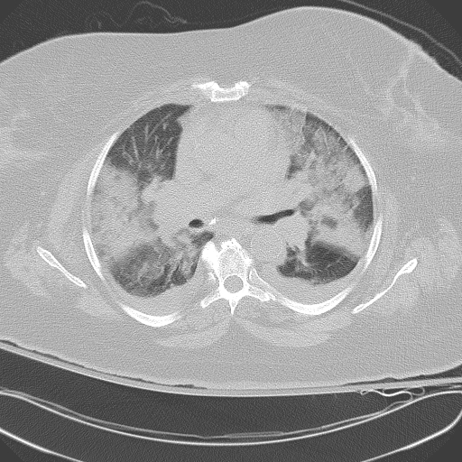 All trans retinoic acid (ATRA) syndrome (Radiopaedia 38212-40229 Axial lung window 26).jpg