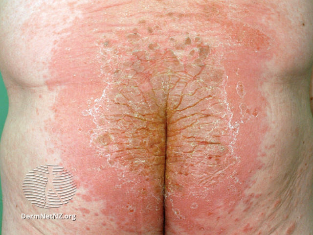 File:Allergy to dimethyl fumarate- sofa dermatitis (DermNet NZ dermatitis-sofa-dermatitis).jpg