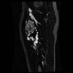 Alveolar soft part sarcoma (Radiopaedia 64501-73678 D 62).jpg