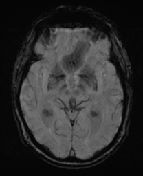 File:Alzheimer's disease- with Gerstmann syndrome and dressing apraxia (Radiopaedia 54882-61150 Axial SWI 16).png
