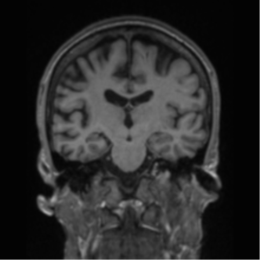 File:Alzheimer's disease- with apraxia (Radiopaedia 54763-61011 Coronal T1 47).png