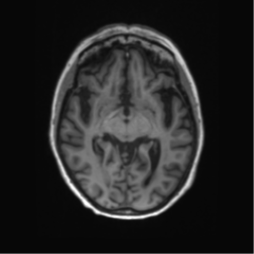 File:Alzheimer's disease (Radiopaedia 42658-45802 Axial T1 88).png