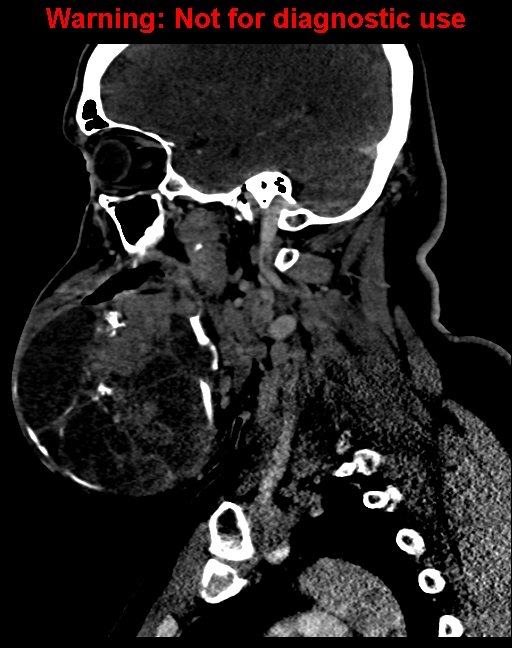 Ameloblastoma (Radiopaedia 33126-34164 F 26).jpg