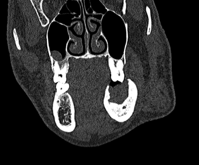 Ameloblastoma (Radiopaedia 51921-57766 Coronal bone window 82).jpg