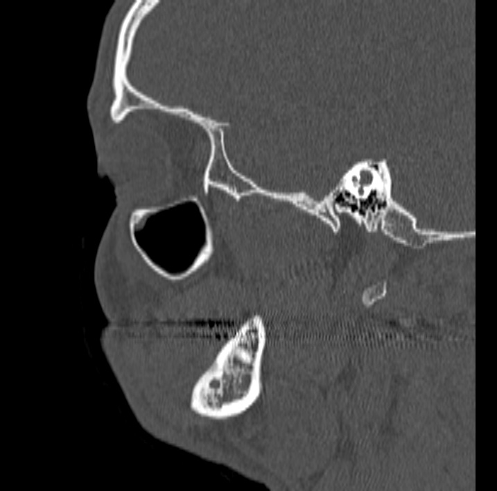 Ameloblastoma (Radiopaedia 77750-89997 Sagittal bone window 68).jpg