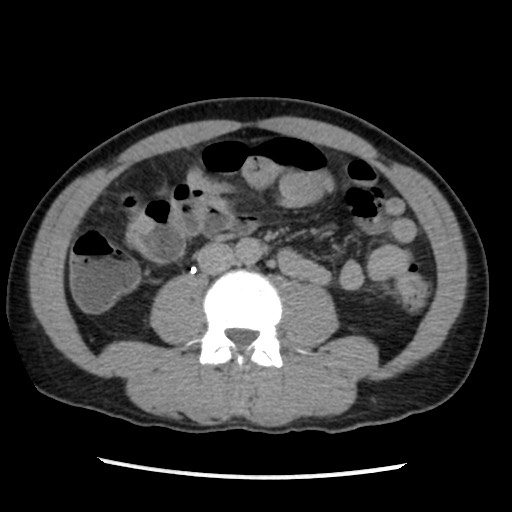 Amoebic liver abscesses (Radiopaedia 55536-62009 Axial C+ delayed 50).jpg