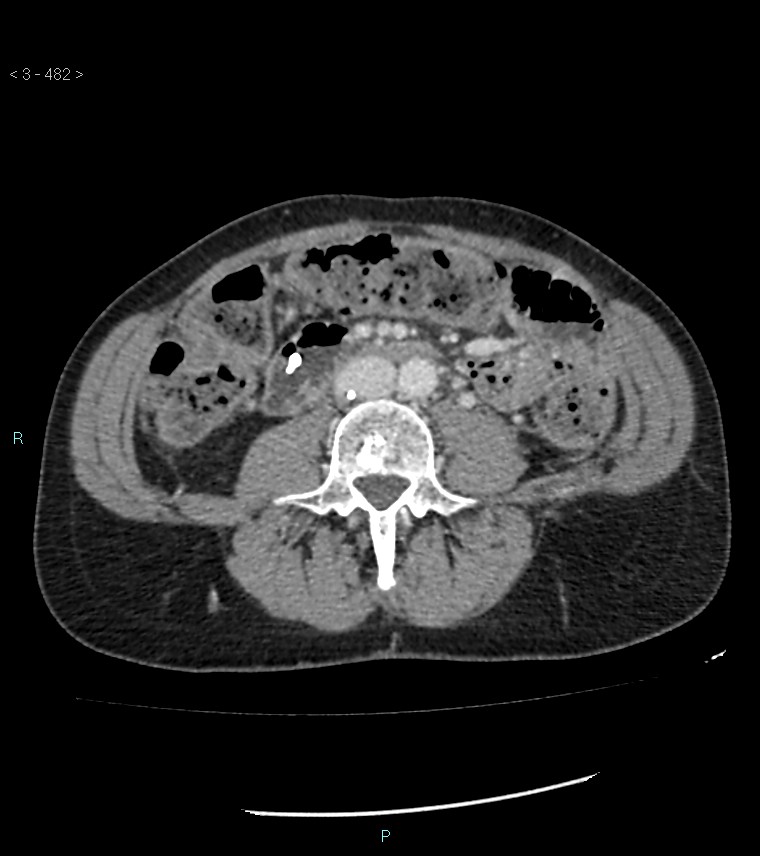 Ampulla of Vater metastasis (Radiopaedia 27820-28069 A 120).jpg