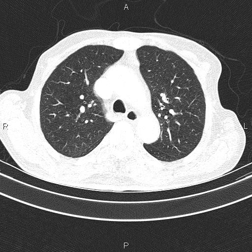 Ampullary adenocarcinoma (Radiopaedia 86093-102033 Axial lung window 25).jpg