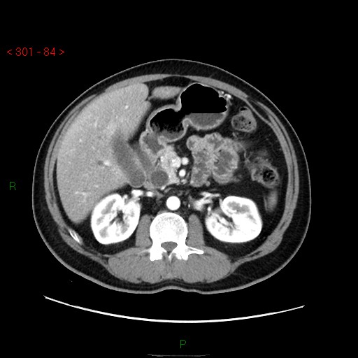 Ampullary carcinoma (Radiopaedia 56396-63056 B 30).jpg