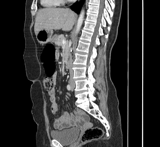 Ampullary tumor (Radiopaedia 60333-67998 C 28).jpg
