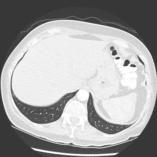 Amyloidosis - bronchial and diffuse nodular pulmonary involvement (Radiopaedia 60156-67745 Axial lung window 77).jpg