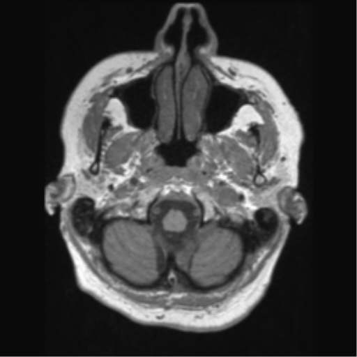 Anaplastic astrocytoma IDH wild-type (pseudoprogression) (Radiopaedia 42209-45276 Axial T1 22).png