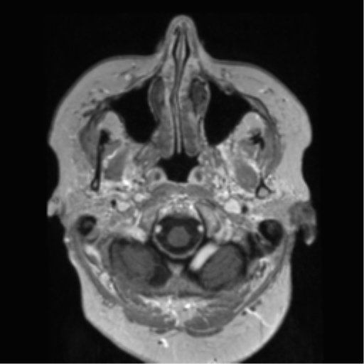 File:Anaplastic astrocytoma IDH wild-type (pseudoprogression) (Radiopaedia 42209-45278 Axial T1 C+ 24).png