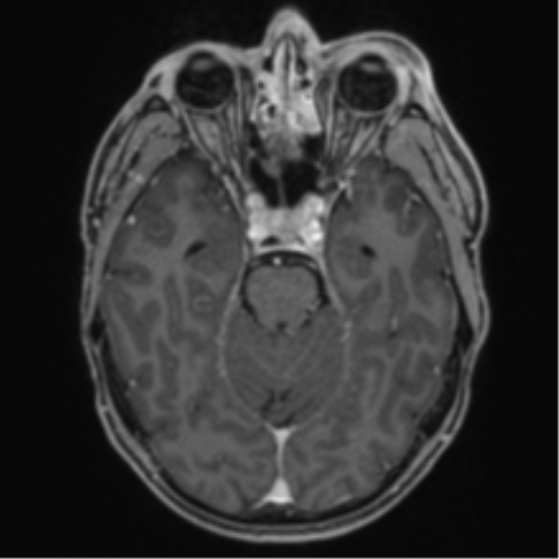 Anaplastic oligodendroglioma with skull fracture (Radiopaedia 74831-85845 Axial T1 C+ fat sat 20).png