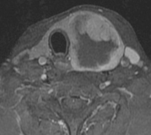 File:Anaplastic thyroid cancer (MRI) (Radiopaedia 13728-13611 Axial T1 C+ fat sat 1).jpg