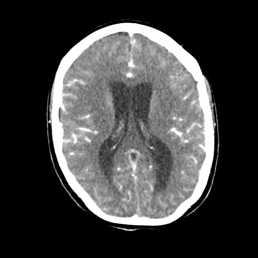 Aneursym related subarachnoid hemorrhage with hydrocephalus (Radiopaedia 45105-49084 D 31).jpg