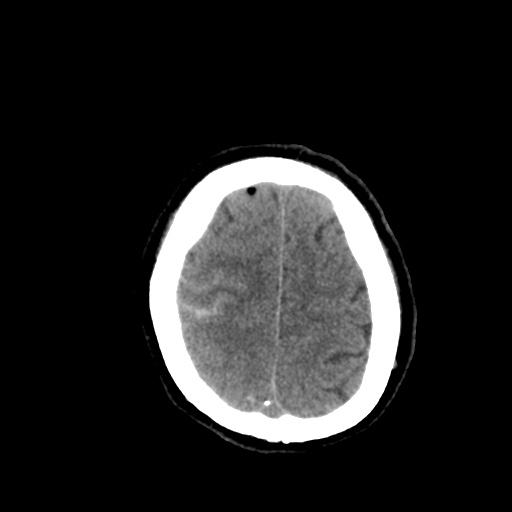 Aneursym related subarachnoid hemorrhage with hydrocephalus (Radiopaedia 45105-49085 Axial non-contrast 43).jpg