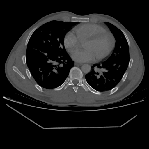 Aneurysmal bone cyst - rib (Radiopaedia 82167-96220 Axial bone window 161).jpg