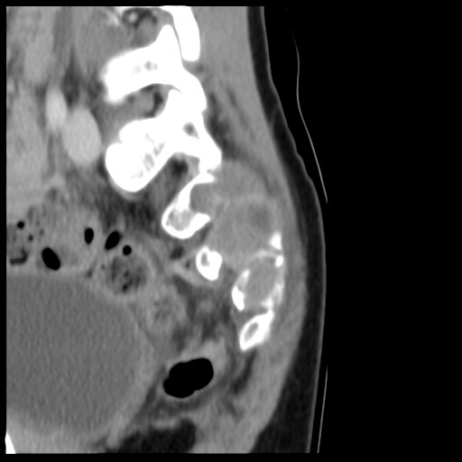 File:Aneurysmal bone cyst - sacrum (Radiopaedia 65190-74195 A 9).jpg