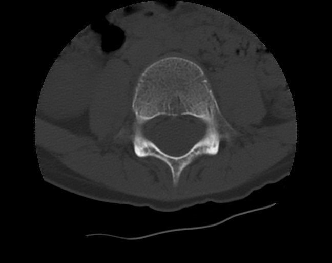 Aneurysmal bone cyst - sacrum (Radiopaedia 65190-74195 Axial bone window 1).jpg