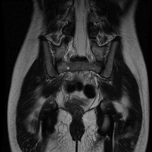 File:Aneurysmal bone cyst - sacrum (Radiopaedia 65190-74196 Coronal T2 12).jpg