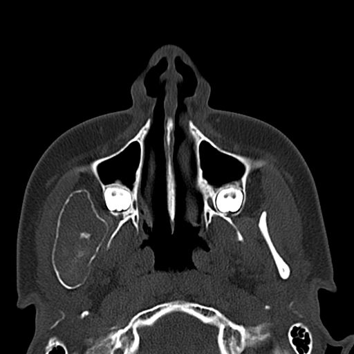 Aneurysmal bone cyst of the mandible (Radiopaedia 43280-46601 Axial bone window 60).jpg