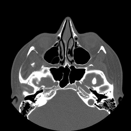 Aneurysmal bone cyst of the mandible (Radiopaedia 43280-46823 Axial bone window 150).jpg