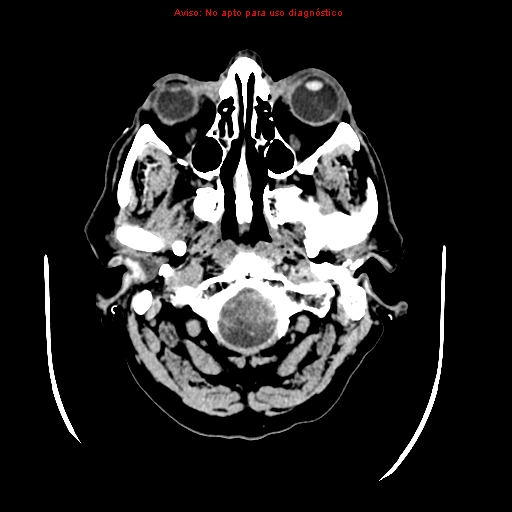 File:Aneurysmal subarachnoid hemorrhage (Radiopaedia 24740-24997 Axial non-contrast 3).jpg