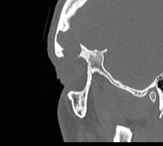 Angular epidermoid cyst (Radiopaedia 46908-51439 Sagittal bone window 84).png