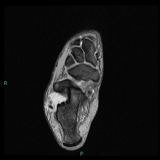 Ankle ganglion cyst (Radiopaedia 62809-71162 Axial Gradient Echo 32).jpg