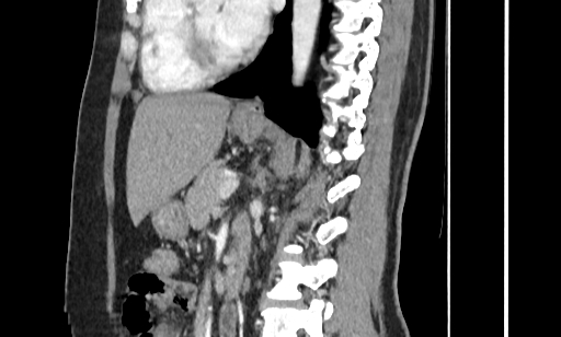 Annular pancreas (Radiopaedia 70359-80453 B 35).jpg