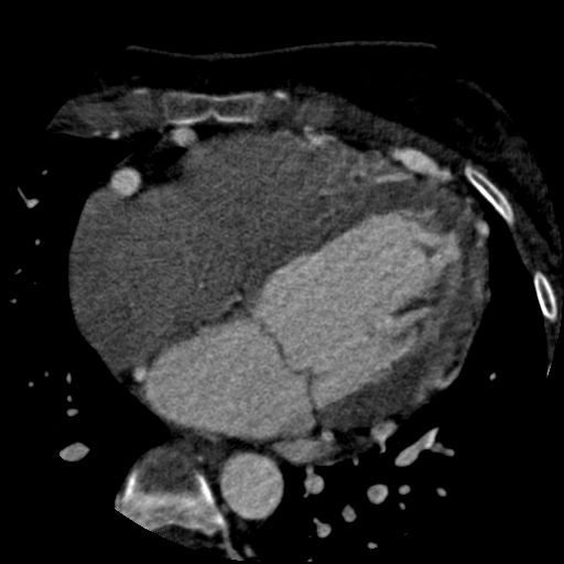 File:Anomalous left coronary artery from the pulmonary artery (ALCAPA) (Radiopaedia 40884-43586 A 48).jpg