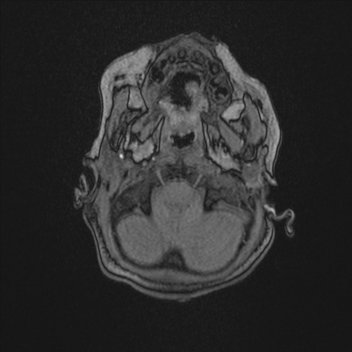 File:Anoxic brain injury (Radiopaedia 79165-92139 Axial MRA 25).jpg