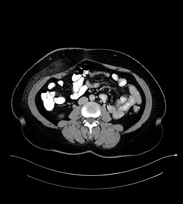 Anterior abdominal wall CSF pseudocyst (CSFoma) (Radiopaedia 79453-92571 A 51).jpg