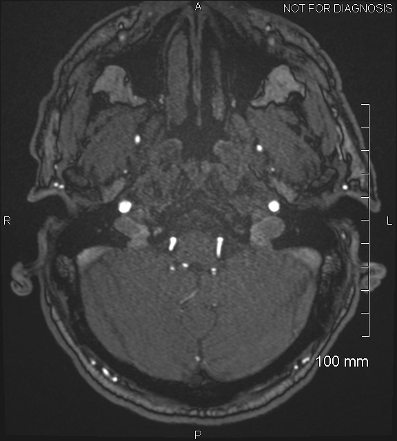 Anterior cerebral artery aneurysm (Radiopaedia 80683-94127 Axial MRA 30).jpg