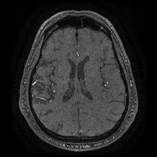 Anterior cerebral artery infarction (Radiopaedia 46794-51323 Axial MRA 132).jpg