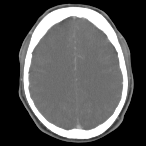 File:Anterior cerebral artery territory infarct (Radiopaedia 39327-41581 B 22).png