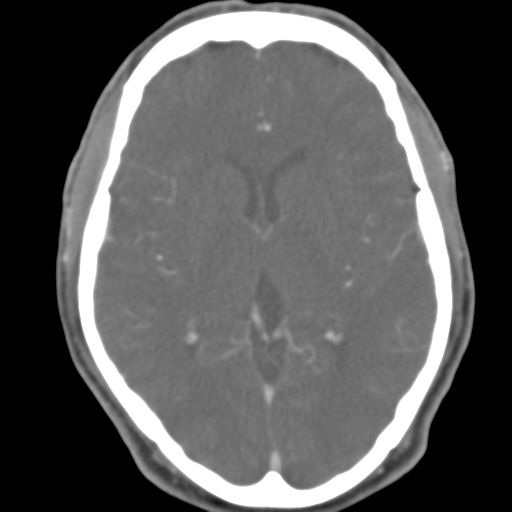 File:Anterior cerebral artery territory infarct (Radiopaedia 39327-41581 B 30).png