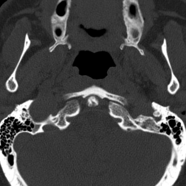 Anterior cervical postdiscectomy arthrodesis (Radiopaedia 32678-33646 Axial bone window 6).jpg
