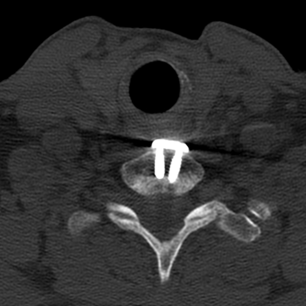 Anterior cervical postdiscectomy arthrodesis (Radiopaedia 32678-33646 Axial bone window 61).jpg