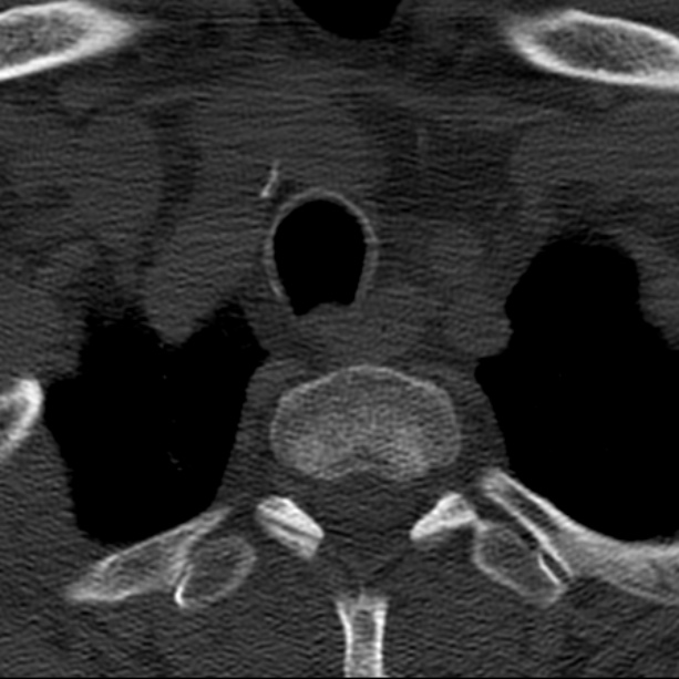 Anterior cervical postdiscectomy arthrodesis (Radiopaedia 32678-33646 Axial bone window 72).jpg