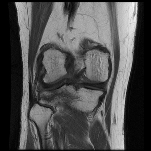 File:Anterior cruciate ligament avulsion fracture (Radiopaedia 58939-66193 Coronal T1 13).jpg