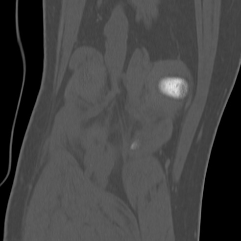 File:Anterior cruciate ligament avulsion fracture (Radiopaedia 58939-66194 Coronal bone window 29).jpg
